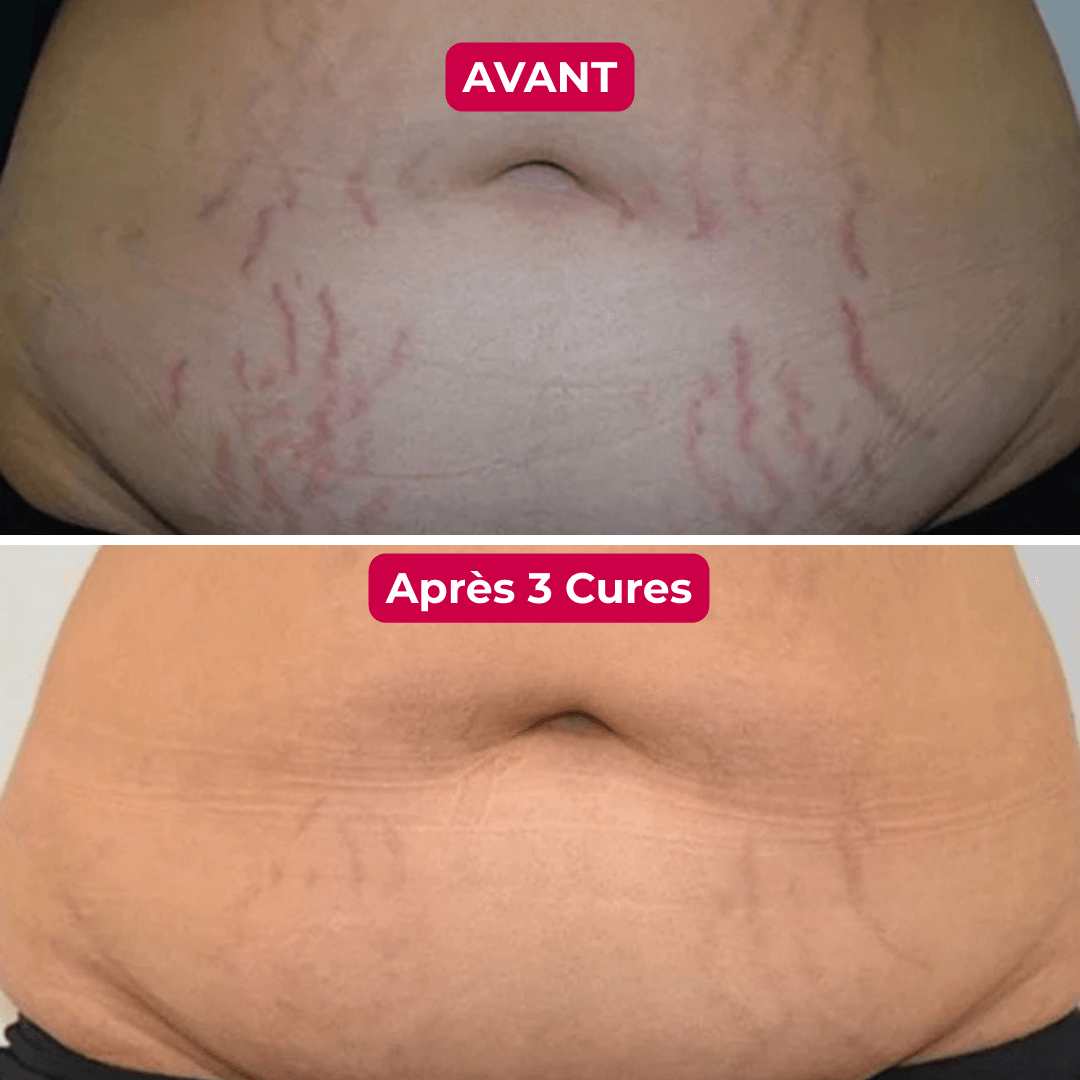 Libérez-Vous des Vergetures avec le Seul Système de Micro-Infusion Clinique à Domicile