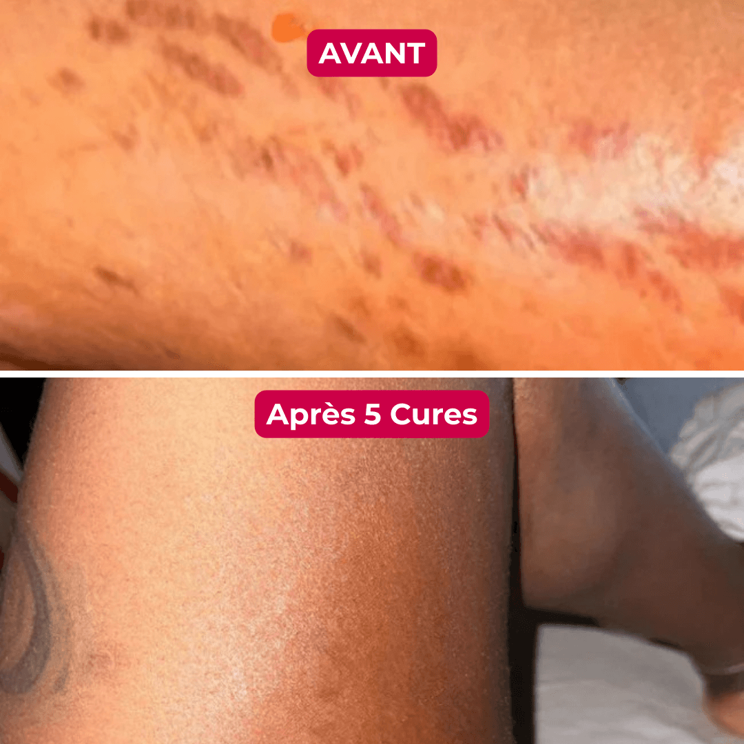 Libérez-Vous des Vergetures avec le Seul Système de Micro-Infusion Clinique à Domicile