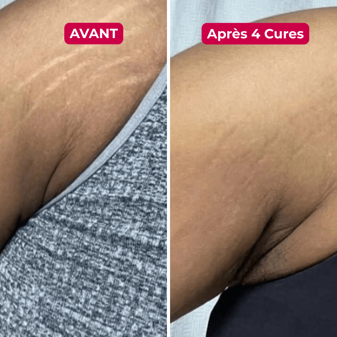 Libérez-Vous des Vergetures avec le Seul Système de Micro-Infusion Clinique à Domicile